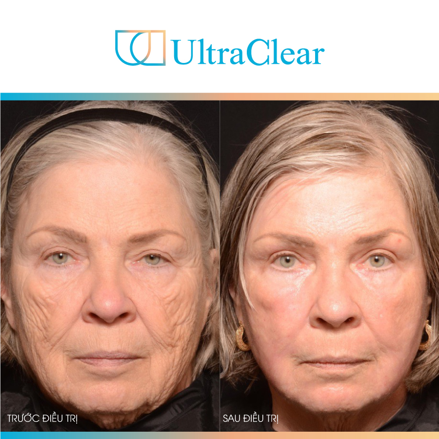 Ultraclear - Phương pháp trẻ hóa da bằng laser rất được ưa chuộng