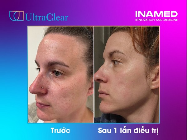 Review laser Ultraclear từ bác sĩ và bệnh nhân