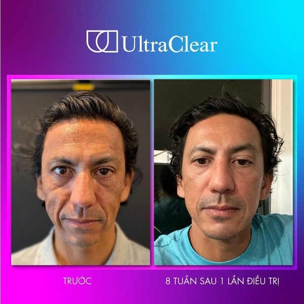 Cơ hội có 1-0-2: Trải nghiệm điều trị Ultraclear miễn phí