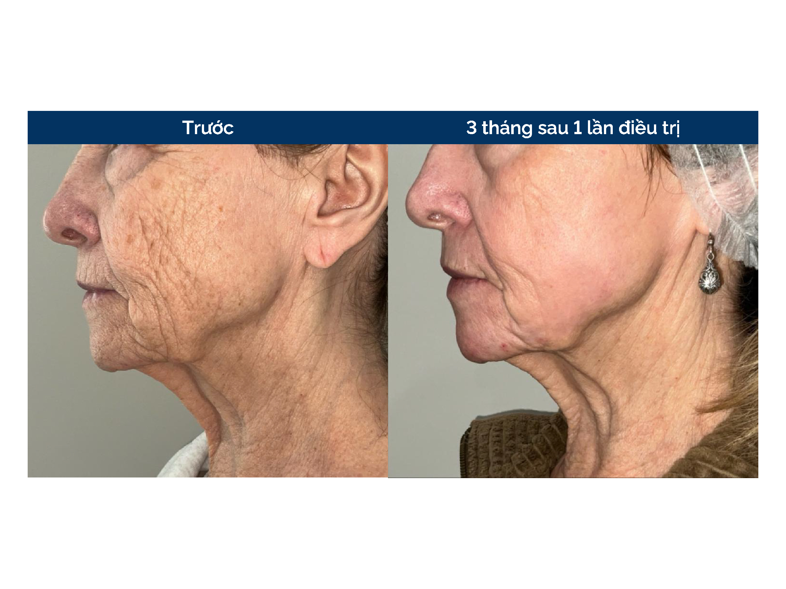 Kết quả điều trị từ Dr. Carolee Cutler Peck, MPH